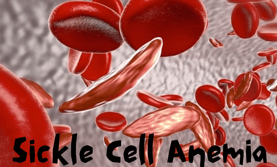 Sickle Cell Anemia